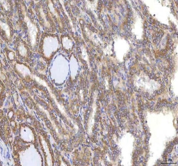 IHC staining of FFPE human thyroid cancer tissue with Oncomodulin 1 antibody. HIER: boil tissue sect