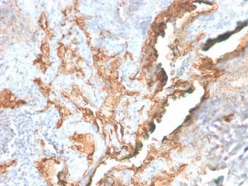 IHC staining of FFPE human lung carcinoma with recombinant Tenascin C antibody (clone TNC/2981R). HI