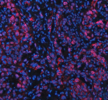Immunofluorescent staining of FFPE human bladder cancer tissue with NFAT5 antibody (red) and DAPI nu