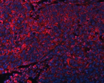 Immunofluorescent staining of FFPE human esophageal squamous cell carcinoma tissue with DOCK1 antibo