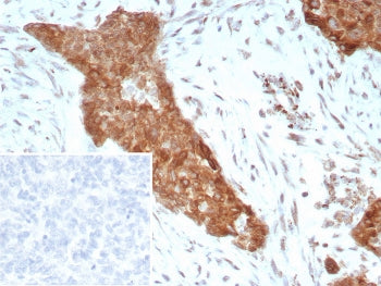 IHC staining of FFPE human ovarian cancer tissue with Tropomyosin-related kinase B antibody (clone N