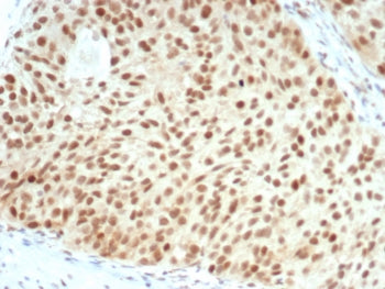 IHC staining of FFPE human bladder carcinoma with recombinant Retinoblastoma antibody (clone RB1/708