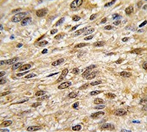 IHC testing of FFPE human lung carcinoma tissue with SHP-1 antibody. HIER: steam section in pH6 citr