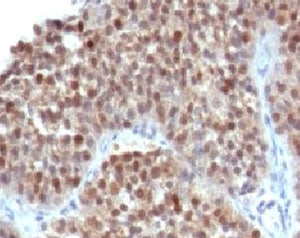 IHC testing of human bladder carcinoma and p21 antibody (WAF21-1). Staining of formalin-fixed tissue