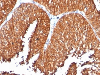 Formalin-fixed, paraffin-embedded human bladder carcinoma stained with anti-HSP60 antibody (clone SP