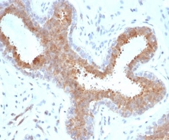 IHC staining of FFPE human breast carcinoma tissue with recombinant BAP1 antibody (clone BAP1/6861R)