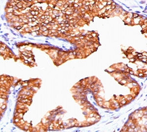 IHC staining of FFPE human prostate carcinoma with PMEPA1 antibody (clone PTAI1-1). HIER: boil tissu