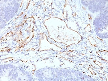 IHC: Formalin-fixed, paraffin-embedded colon carcinoma stained with CD31 antibody cocktail (C31.3+C3