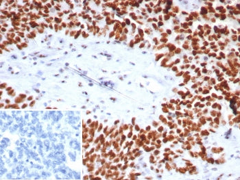 IHC staining of FFPE human ovarian cancer tissue with Nucleolin antibody (clone NCL/7743). HIER: boi