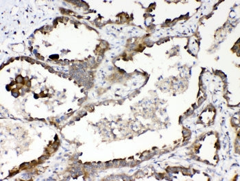IHC testing of FFPE human lung cancer tissue with RanBP1 antibody at 1ug/ml. Required HIER: steam se