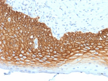 IHC testing of FFPE human cervical carcinoma with CD44v3 antibody (clone 3G5). Required HIER: steam 