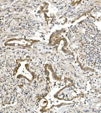 IHC staining of FFPE human rectal cancer with Nectin 1 antibody. HIER: boil tissue sections in pH8 E