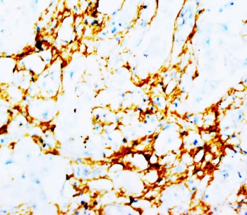 IHC-P: Tenascin antibody testing of human breast cancer tissue. HIER: steamed with pH6 citrate buffe