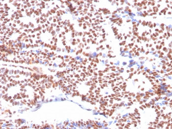 IHC staining of FFPE human breast carcinoma with Estrogen Receptor alpha antibody (clone ESR1/3564).