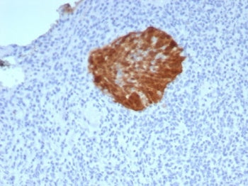 IHC staining of FFPE human cervical carcinoma tissue with P16INK4a antibody (clone CDKN2A/7660R). HI