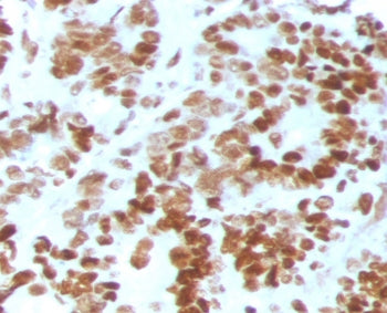 IHC staining of FFPE human colon carcinoma with MSH6 antibody (clone MST6-2). HIER: boil tissue sect