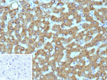 IHC staining of FFPE human hepatocellular carcinoma tissue with HSD17B13 antibody (clone HSD17B13/13