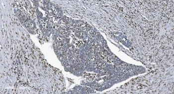 IHC staining of FFPE human ovarian serous adenocarcinoma tissue with SAMHD1 antibody. HIER: boil tis