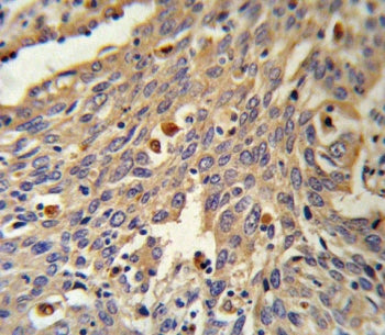 IHC testing of FFPE human lung carcinoma tissue with Galactosidase alpha antibody. HIER: steam secti