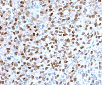 IHC staining of FFPE human melanoma with recombinant MITF antibody (clone MPAF3-2R). HIER: boil tiss