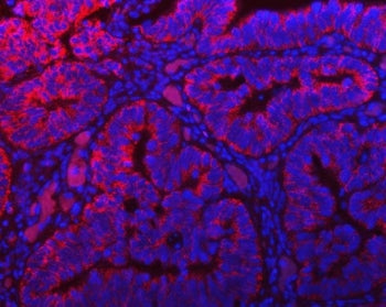 Immunofluorescent staining of FFPE human colon cancer tissue with TOMM40 antibody (red) and DAPI nuc