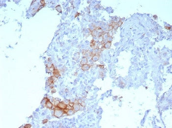 IHC staining of FFPE human lung SqCC with Programmed cell death 1 ligand 1 antibody (clone PDL1/7568
