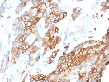 IHC staining of FFPE human breast carcinoma with Neuregulin-1 antibody (clone NRG1/2710). HIER: boil