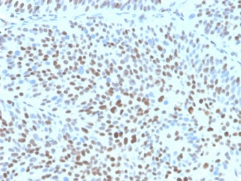IHC staining of FFPE human bladder tissue with recombinant p27Kip1 antibody (clone clone KIP1/1355R) at 2ug/ml. HIER: boil tissue sections in pH 9 10mM Tris with 1mM EDTA for 20 min and allow to cool before testing. Strong nuclear staining observed.