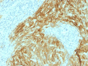 IHC testing of FFPE human follicular dendritic cell sarcoma with CD21 antibody (clone CR2/1952). HIE