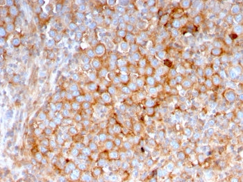 IHC testing of FFPE human urothelial carcinoma with SERBP1 antibody (clone SERBP1/3495). Required HI