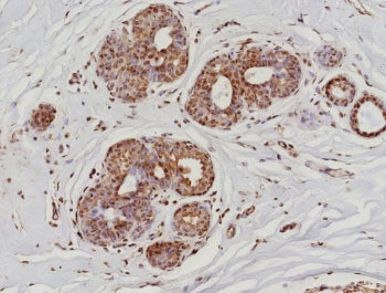 IHC staining of FFPE human breast cancer tissue with recombinant Phospho-RNA Polymerase II CTD Repea