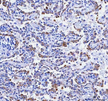 IHC staining of FFPE human lung cancer tissue with Ribosome binding protein 1 antibody. HIER: boil t