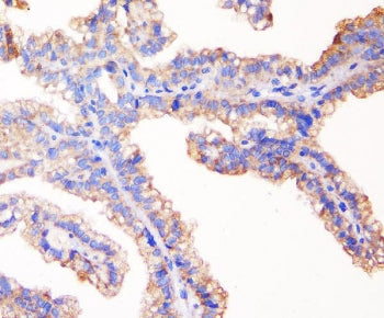 IHC staining of FFPE human kidney cancer with TJP1 antibody. HIER: boil tissue sections in pH6, 10mM
