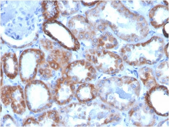 IHC testing of FFPE human pancreatic carcinoma with biotinylated TROP2 antibody (clone TACSTD2/2151)