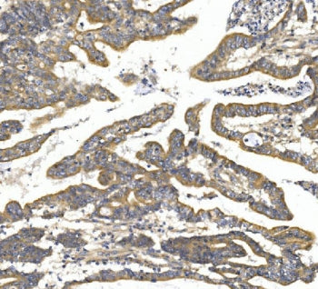 IHC staining of FFPE human rectal cancer with TTK antibody. HIER: boil tissue sections in pH8 EDTA f