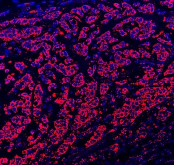 Immunofluorescent staining of FFPE human breast cancer tissue with Paxillin antibody (red) and DAPI 