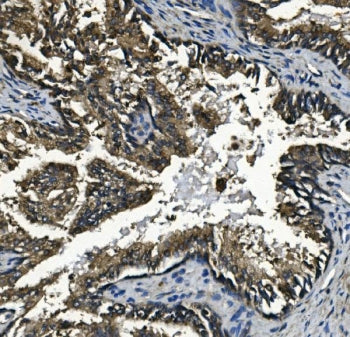 IHC staining of FFPE human prostate cancer with Glucosidase Alpha Acid antibody. HIER: boil tissue s
