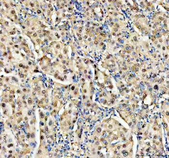 IHC staining of FFPE human liver cancer tissue with NUDT5 antibody. HIER: boil tissue sections in pH