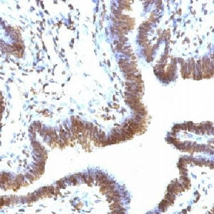 IHC testing of FFPE human ovarian carcinoma and EMI-1 antibody (clone FBXP5). Staining of formalin-f
