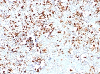 IHC staining of FFPE human colon carcinoma tissue with Myelin Protein Zero antibody (clone MPZ/7389)