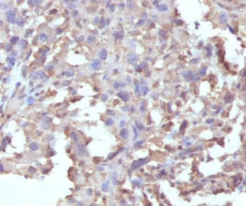 IHC staining of FFPE human histiocytoma with recombinant TNF alpha antibody (clone RMTNFA-1). Requir