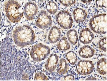IHC staining of FFPE human rectal cancer with BubR1 antibody. HIER: boil tissue sections in pH8 EDTA