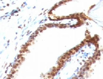 IHC: Formalin-fixed, paraffin-embedded human colon carcinoma stained with Double Stranded DNA antibo