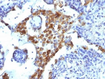 IHC: Formalin-fixed, paraffin-embedded human lung adenocarcinoma stained with Napsin-A antibody (NAP