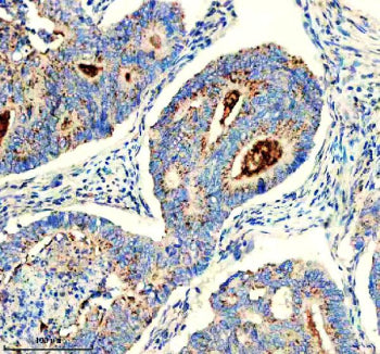 IHC staining of FFPE human colon cancer tissue with CHMP2B antibody, HRP-secondary and DAB substrate