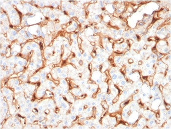 IHC staining of FFPE human hepatocellular carcinoma with Complement C1q B-Chain antibody. HIER: boil