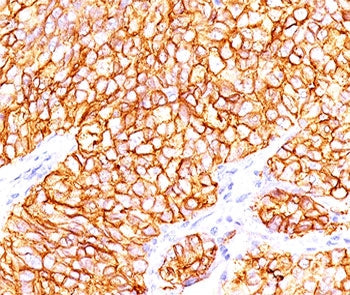 IHC testing of formalin-paraffin human renal cell carcinoma stained with CAIX antibody (66.4.C2). No