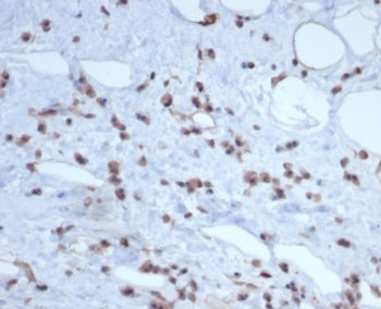 IHC staining of FFPE human liposarcoma tissue with MDM2 antibody (clone MDM2/7189R). HIER: boil tiss
