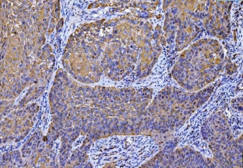 IHC staining of FFPE human laryngeal squamous cell carcinoma tissue with MCART1/2 antibody. HIER: bo
