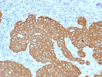 IHC staining of FFPE human basal cell carcinoma with Cytokeratin 5 antibody (clone KRT5/2080). HIER: